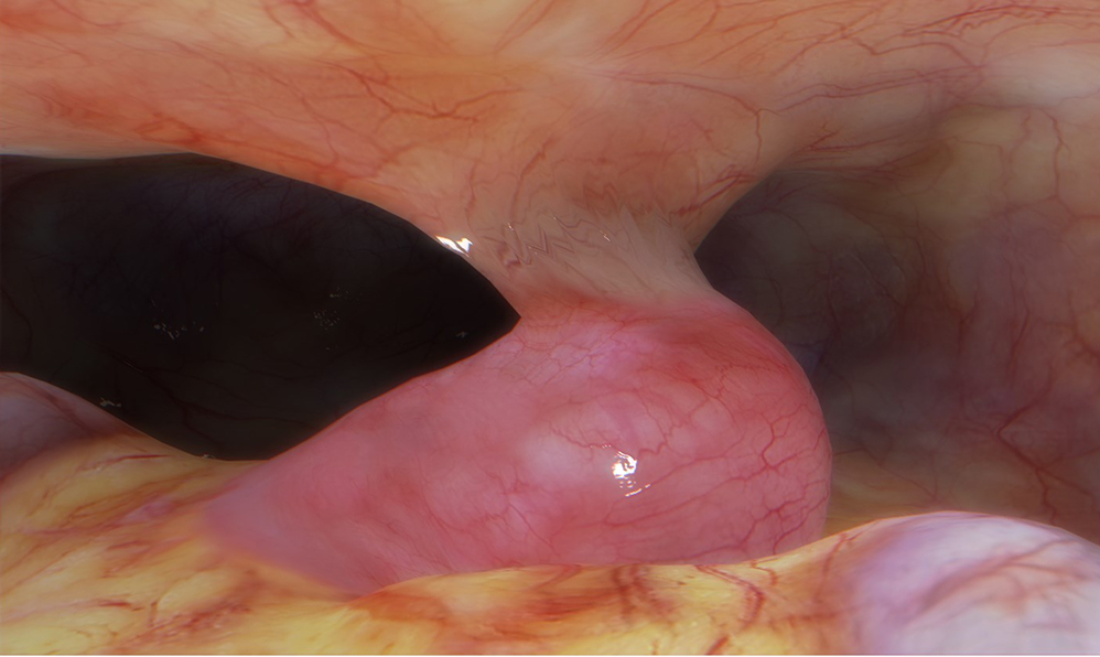 Acute small bowel adhesive obstruction