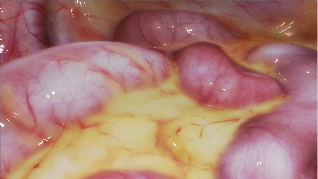 Diagnostic laparoscopy