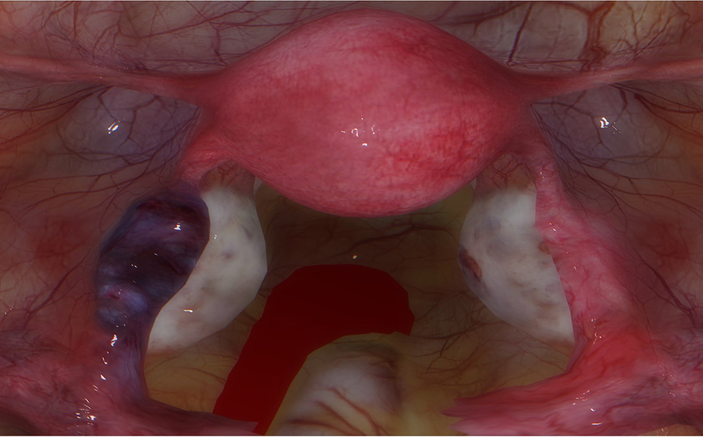 Gynecological surgery skills