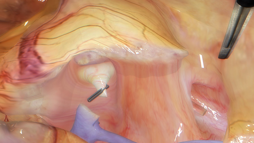 Laparoscopic nephrectomy procedural skills