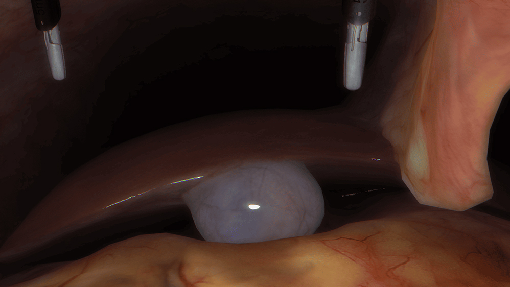 Laparoscopic cholecystectomy procedural skills
