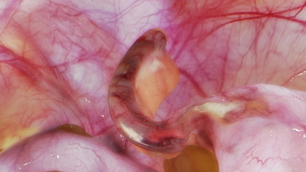 Laparoscopic appendectomy