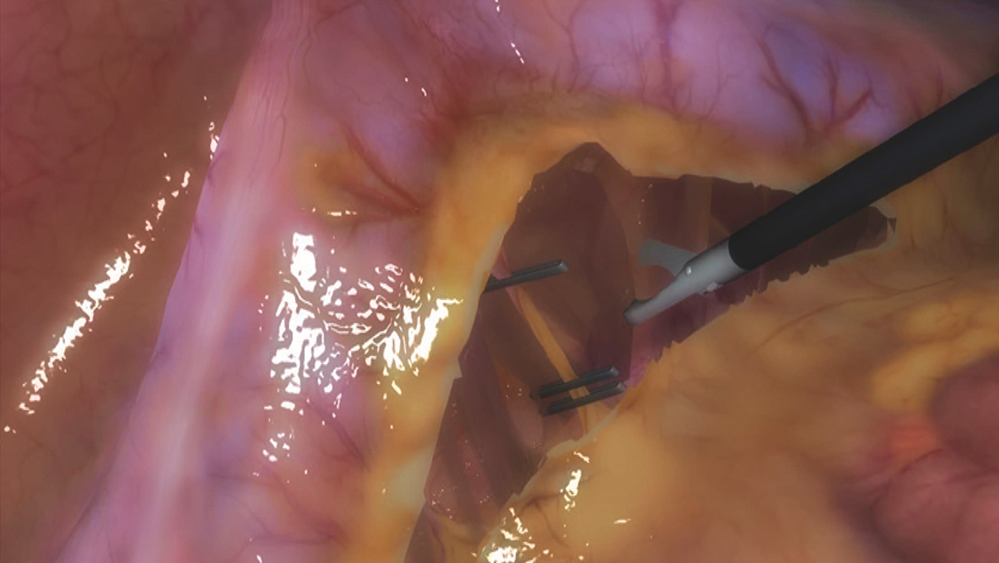Sigmoid colon resection