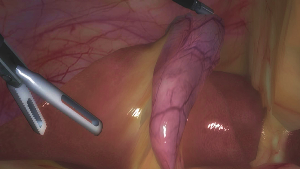 Total laparoscopic cholecystectomy