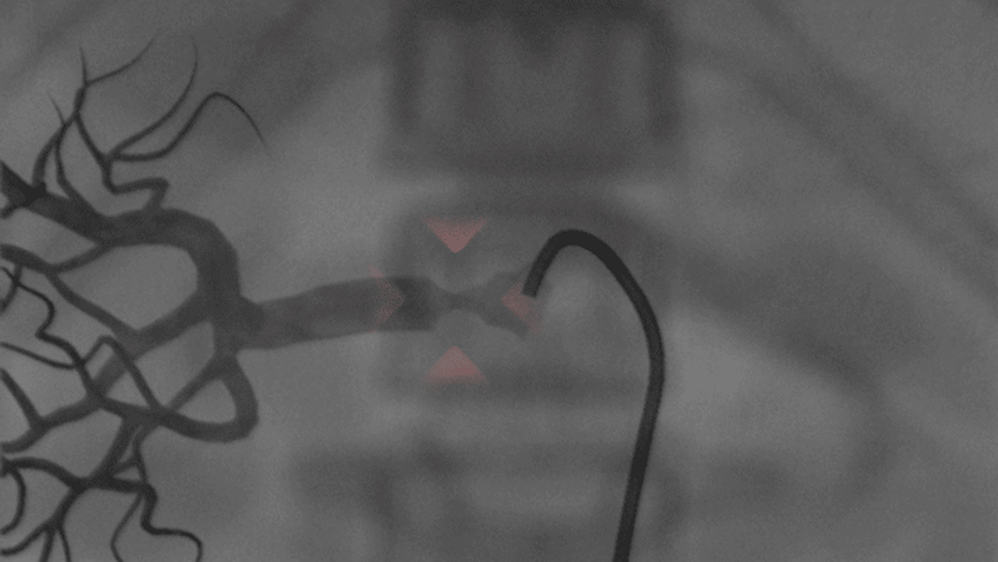 Balloon Angioplasty and Stenting: Coronary Stenting