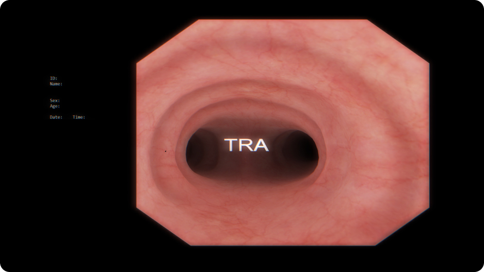Bronchoscopy: Bronchial tree anatomy recognition