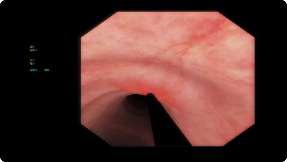 Bronchoscopy: TBNA (Transbronchial Needle Aspiration)