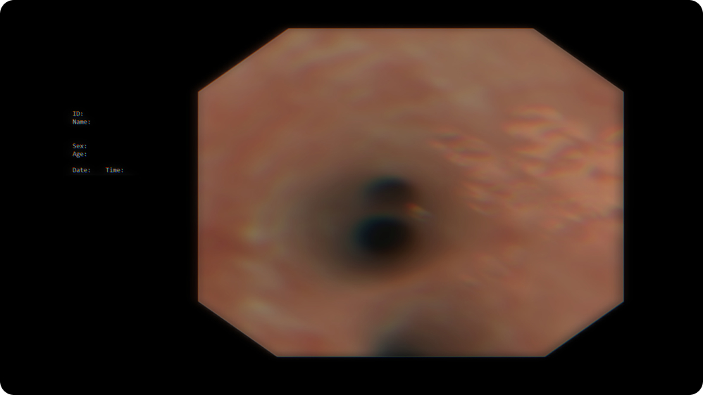 Diagnostic Bronchoscopy: Bronchoalveolar lavage (BAL)