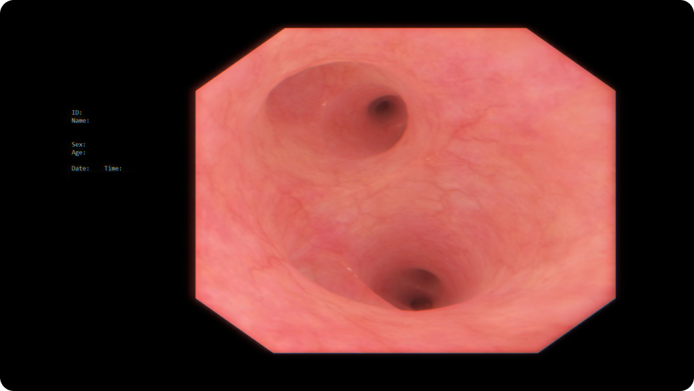 Diagnostic Bronchoscopy: Pediatric bronchoscopy