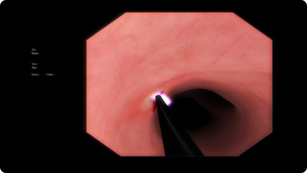 Therapeutic Bronchoscopy: Hemostasis