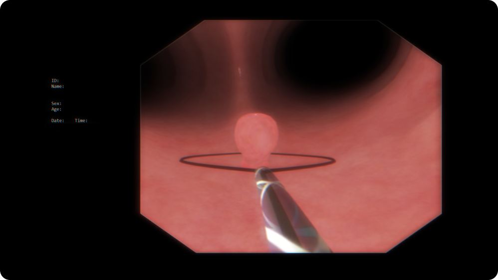 Therapeutic Bronchoscopy: Endoscopic polypectomy