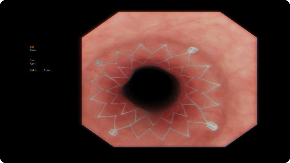 Therapeutic Bronchoscopy: Airway stenting