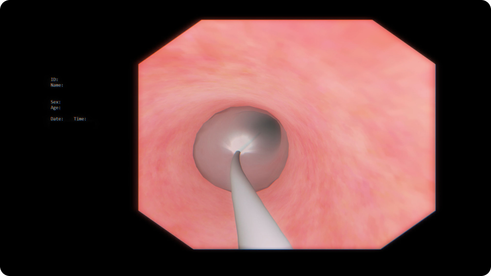 Therapeutic Upper GI Endoscopy: Balloon dilation
