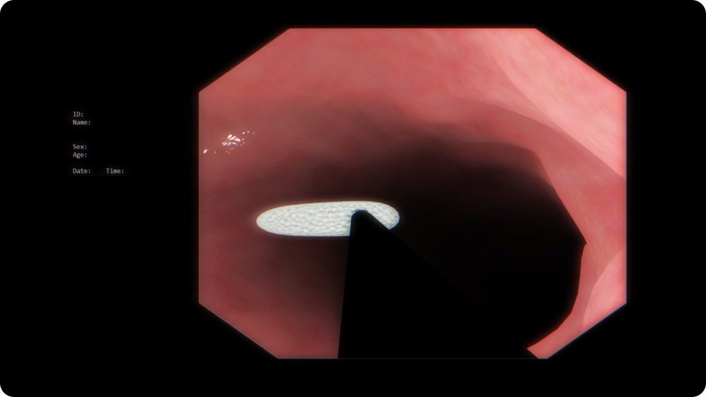 Therapeutic Upper GI Endoscopy: Foreign body removal