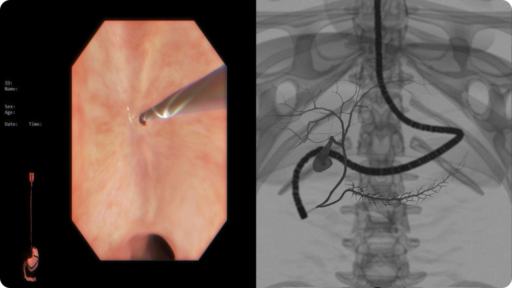 Diagnostic Upper GI Endoscopy: Endoscopic Retrograde Cholangiopancreatography (ERCP)