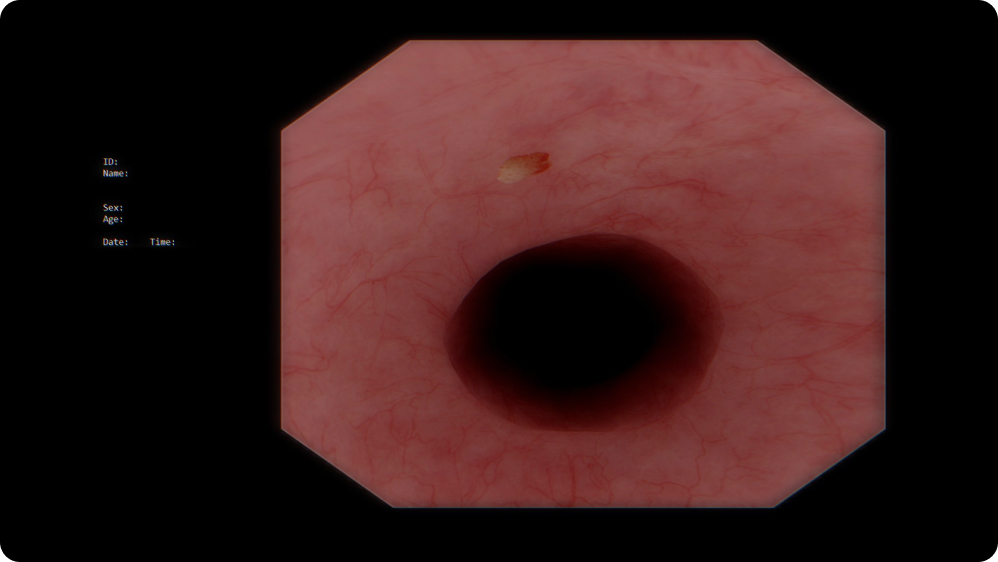 Lower GI Endoscopy: Mucosal assessment in colonoscopy