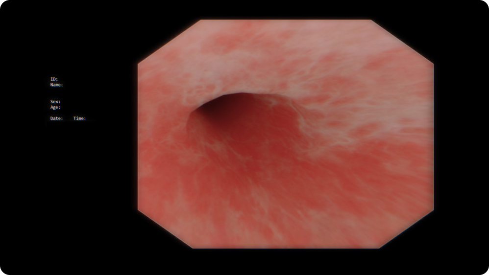 Lower GI Endoscopy: Colonoscopy