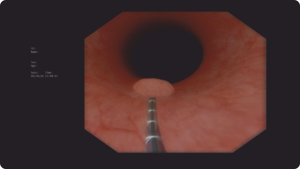 Endoscopic Mucosal Resection (EMR)