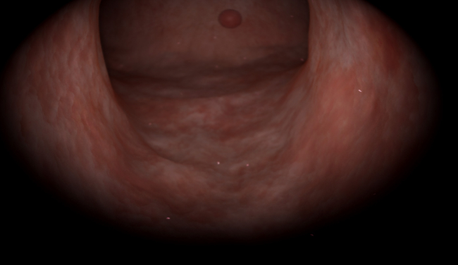 Gynecology: Basic Skills — 30° Oblique-viewing hysteroscope handling skills