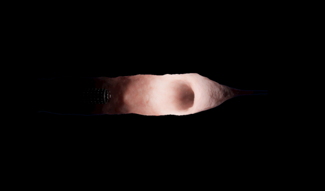 Gynecology: Basic Skills — Introduction to the hysteroscopic pump