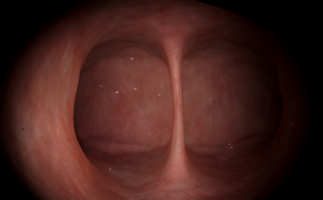 Gynecology: Basic Skills — Resection of the intrauterine septum