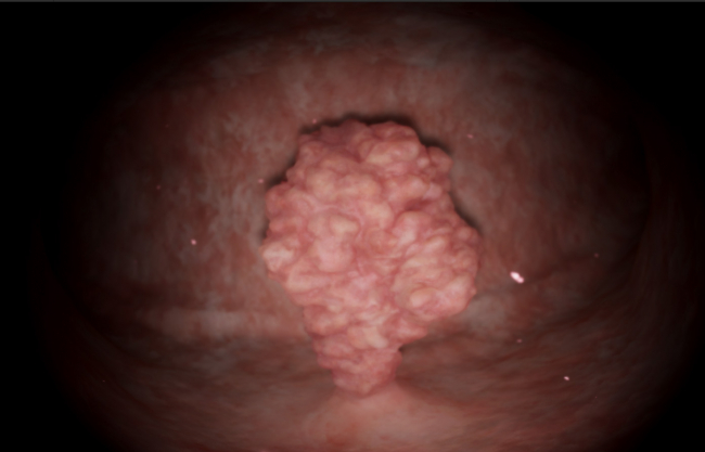 Gynecology: Basic Skills — Polypectomy (Polyp resection).