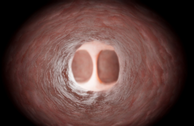 Gynecology: Advanced Resection — Extended resection of the intrauterine septum