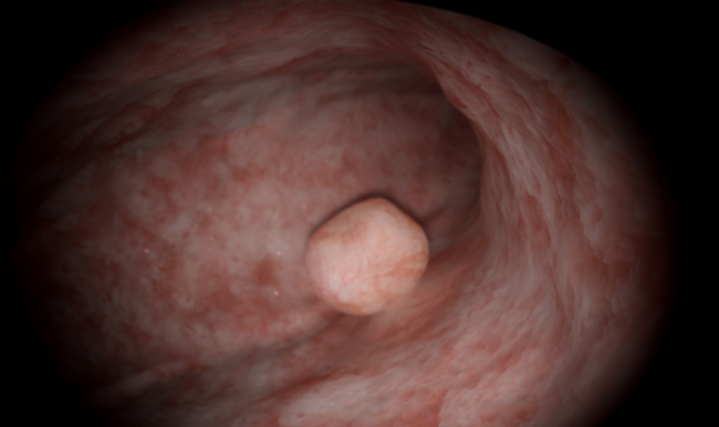 Gynecology: Advanced Resection — Myomectomy: ESGE Type 0 (Case 1)