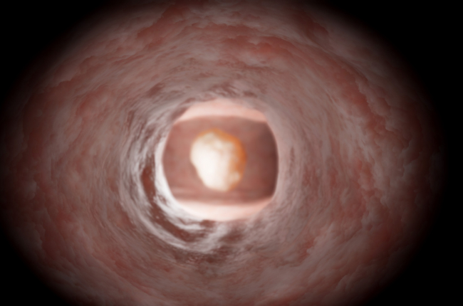 Gynecology: Advanced Resection — Myomectomy: ESGE Type 0 (Case 2)