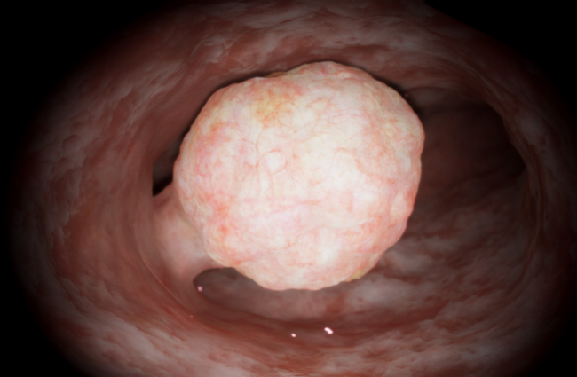 Gynecology: Advanced Resection — Myomectomy: ESGE Type 1–2