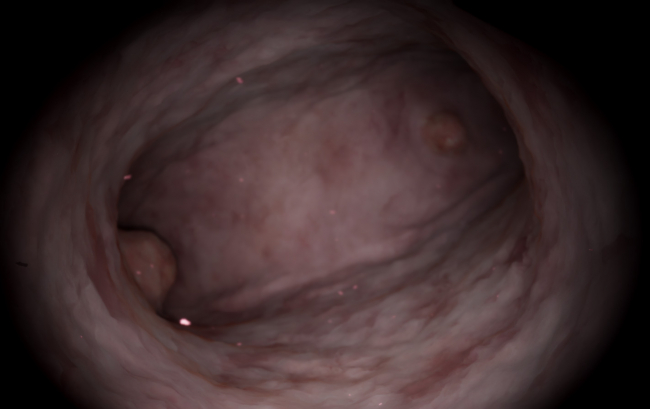 Diagnostic Hysteroscopy