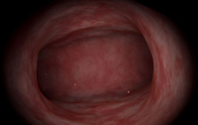 Endometrial Ablation
