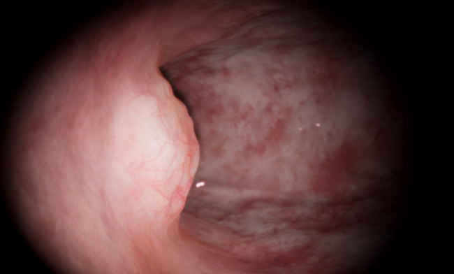 Submucous Myomectomy