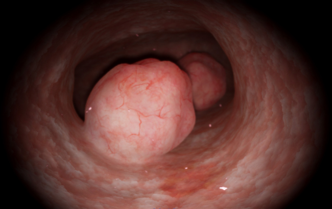 Polypectomy