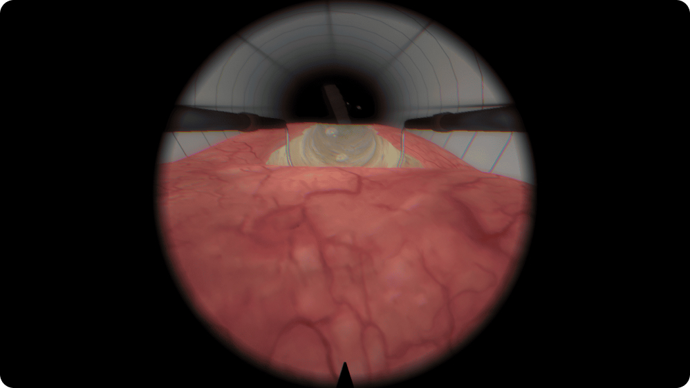Urology: Resection of the Prostatic Lobe