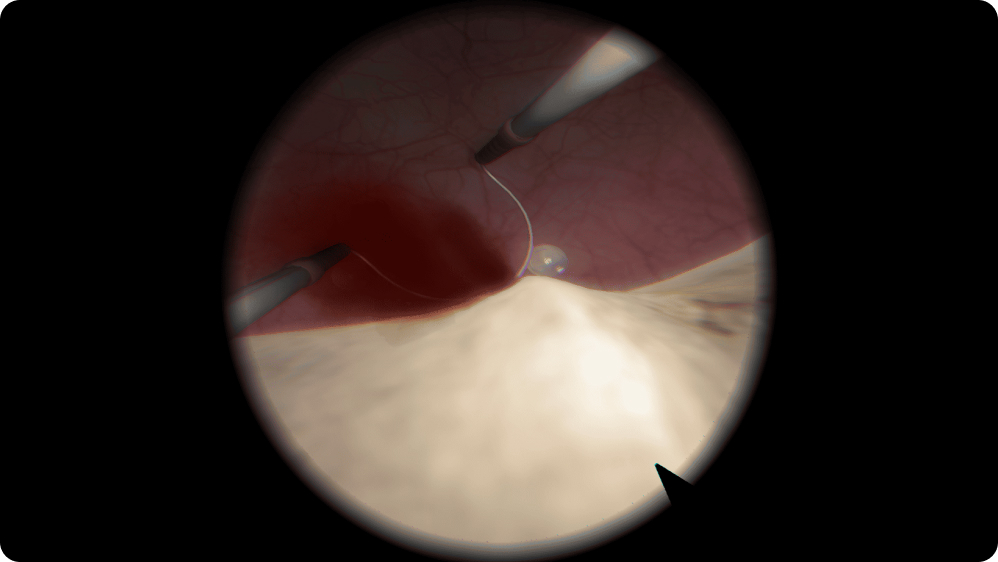 Urology: Hemostasis Control