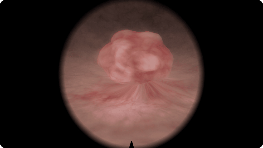 Urology: Transurethral Resection of Bladder Tumor (TURBT) - Polyp: 2–3 cm diameter, 1–2 cm base; posterior and left wall