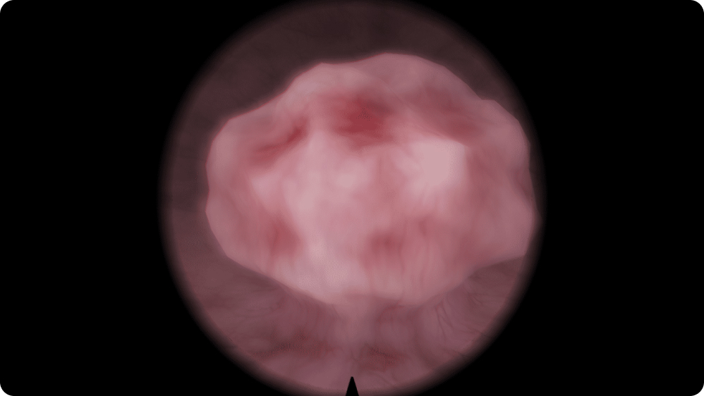 Urology: Transurethral Resection of Bladder Tumor (TURBT) - Polyp: 5 cm diameter, 2.5–3 cm base; posterior and left wall