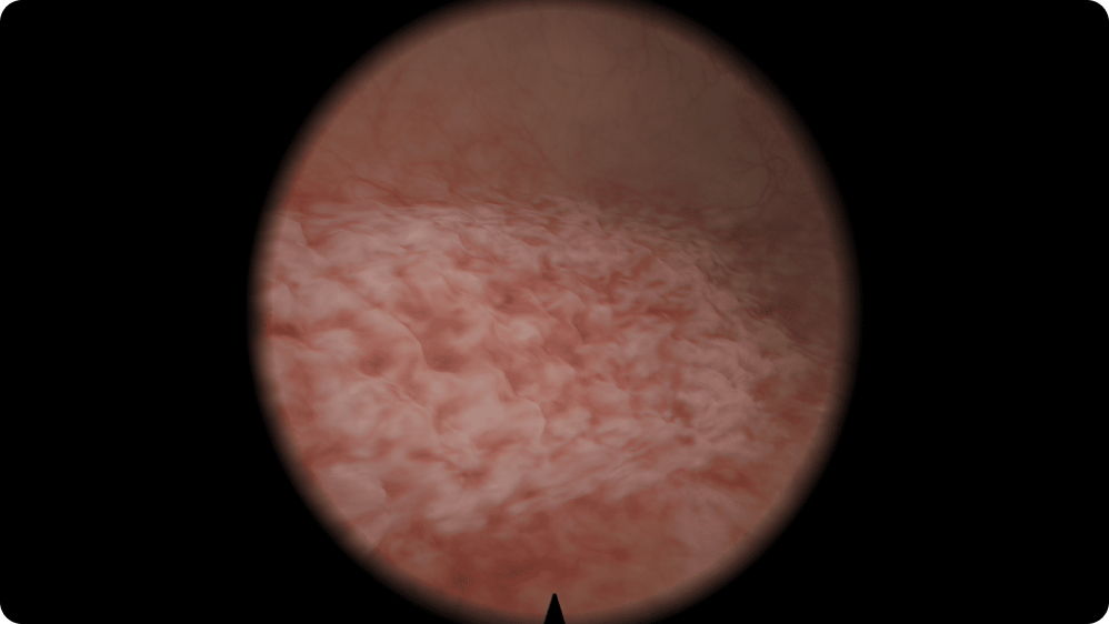 Urology: Transurethral Resection of Bladder Tumor (TURBT) - Sessile polyp: 1 cm height, 3x2 cm base; right wall