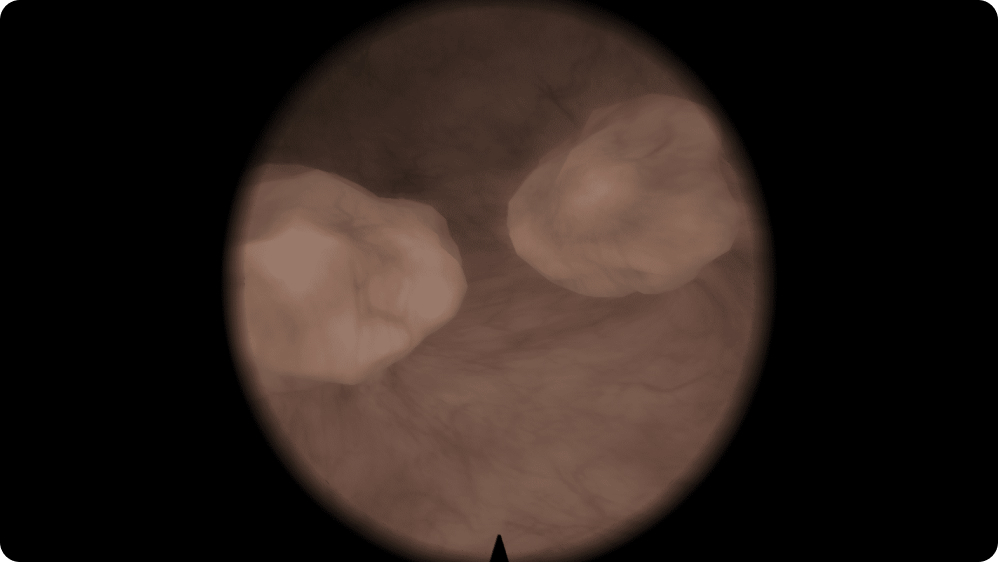 Urology: Transurethral Resection of Bladder Tumor (TURBT) - Two polyps: 4 cm and 3 cm diameter, 2x2 cm and 2 cm bases; posterior and left walls