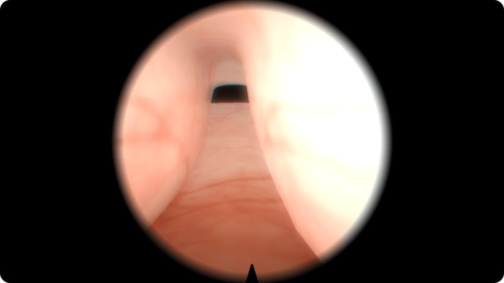 Urology: Transurethral Resection of the Prostate (TURP) - Large adenoma with median lobe