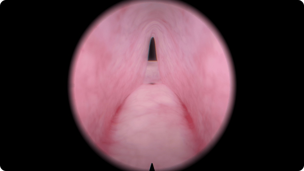 Urology: Transurethral Resection of the Prostate (TURP) - Large adenoma with lateral lobes, without median lobe