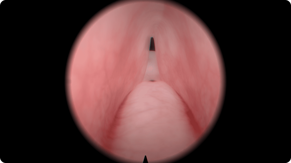 Urology: Transurethral Resection of the Prostate (TURP) - Large adenoma with lateral and median lobe