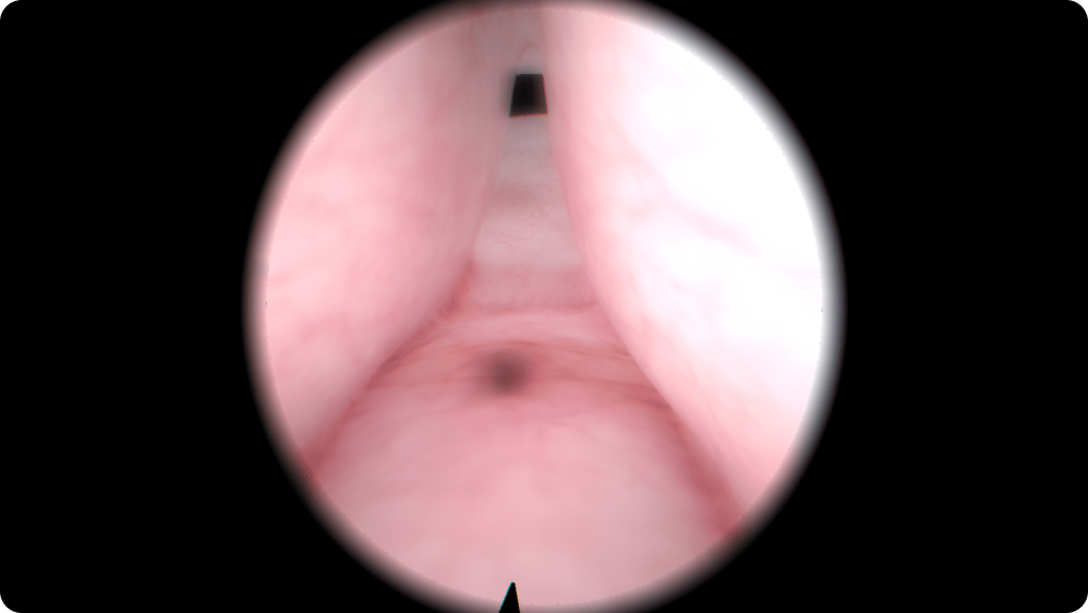 Urology: Transurethral Resection of the Prostate (TURP) - Medium-sized adenoma with median lobe