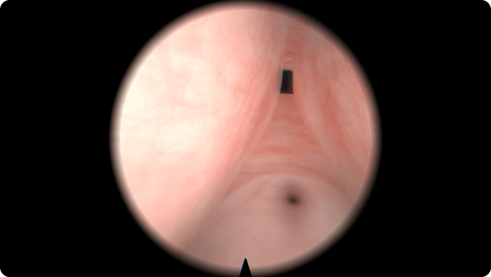 Urology: Transurethral Resection of the Prostate (TURP) - Medium-sized adenoma without median lobe