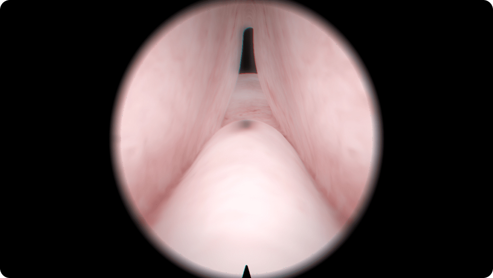 Urology: Transurethral Resection of the Prostate (TURP) - Small adenoma with median lobe