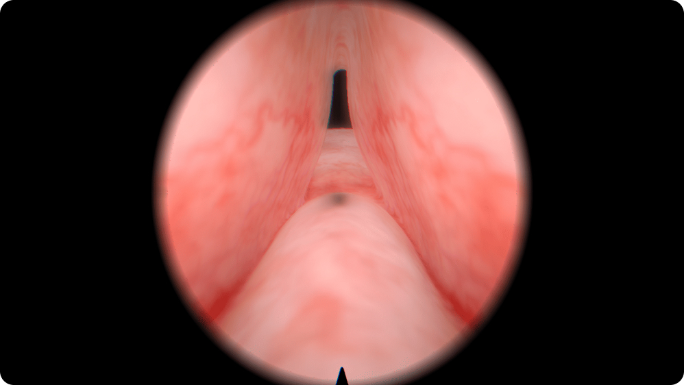 Urology: Transurethral Resection of the Prostate (TURP) - Small adenoma without median lobe